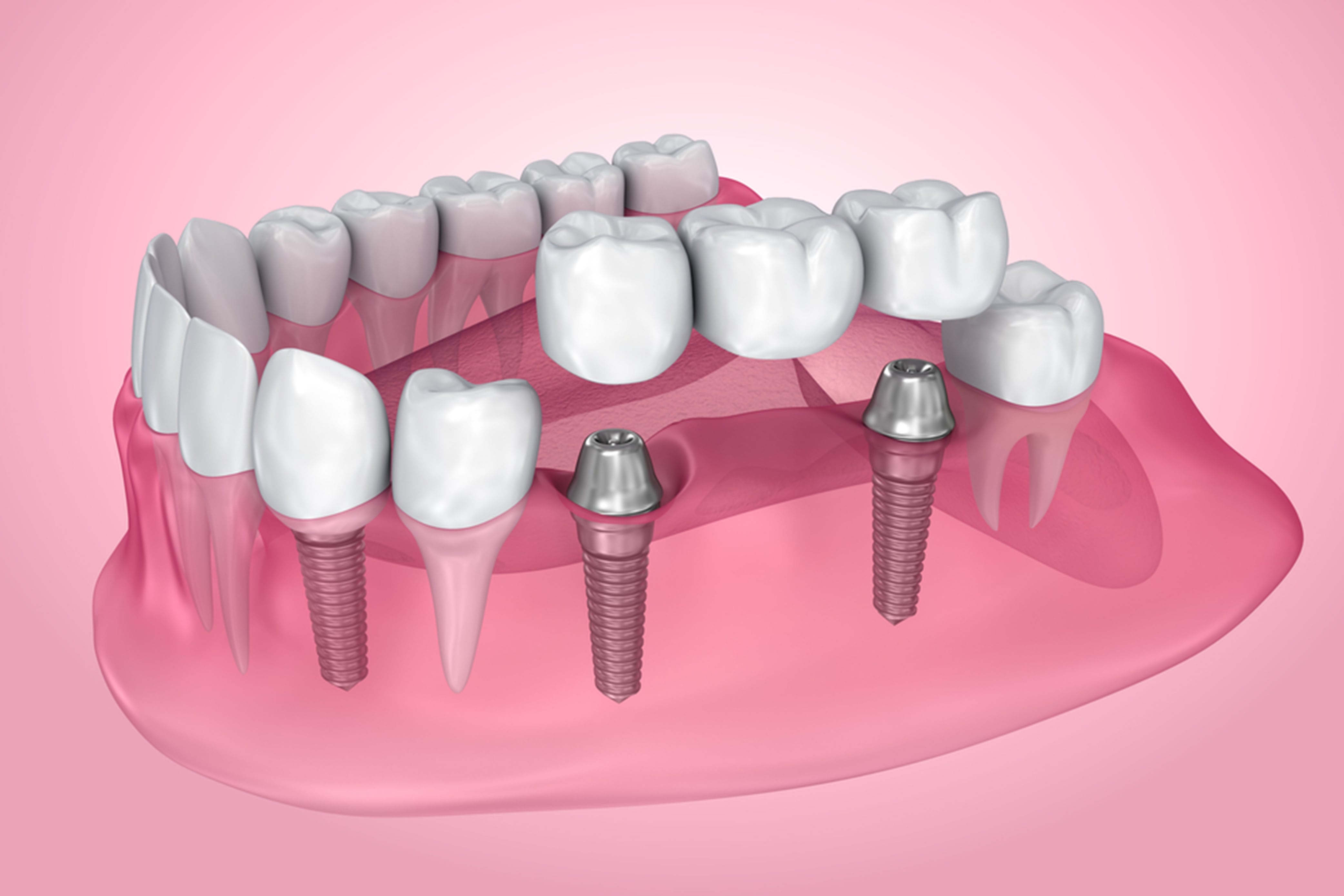 Why Dental Implants Are the Right Option for you