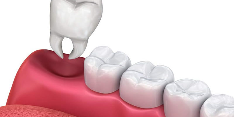 all you need to know about tooth extractions