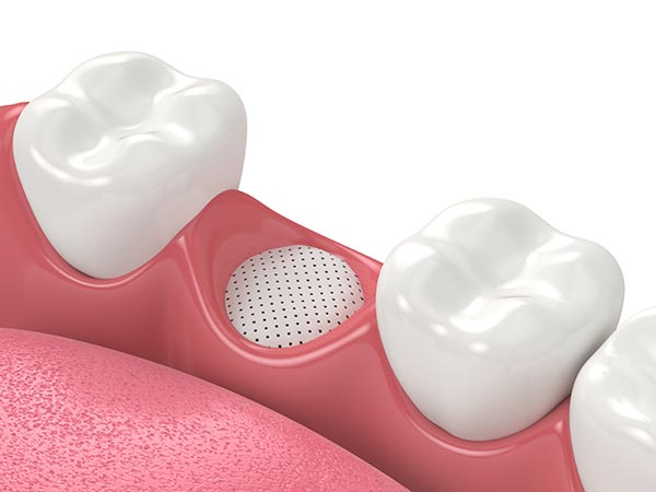 bone-graft-socket-preservation bone graft socket preservation