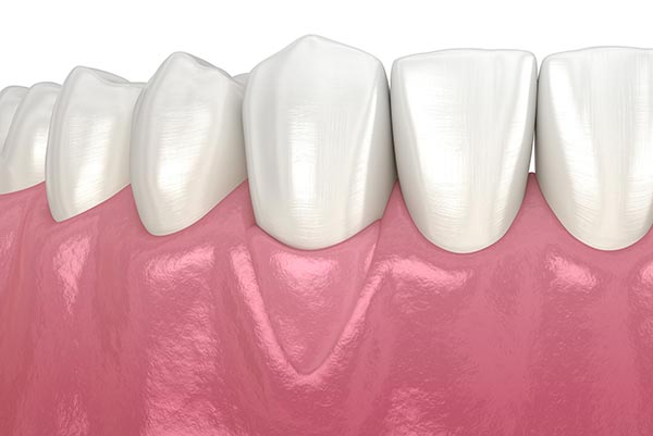 gum-graft gum graft