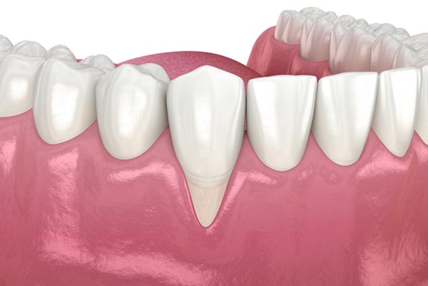 receding-gums receding gums