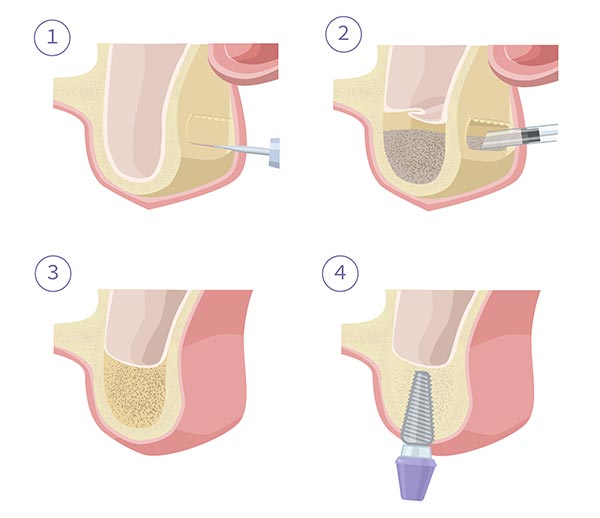 sinus graft