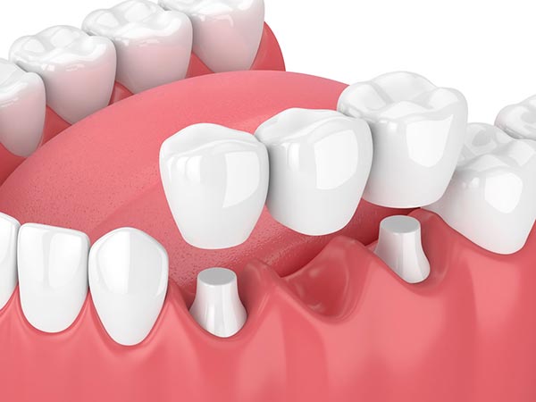 traditional-dental-bridge traditional dental bridge