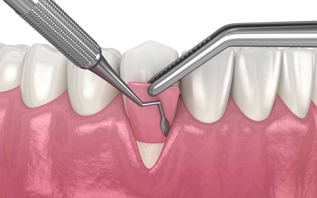 Is Gum Graft Surgery Painful?