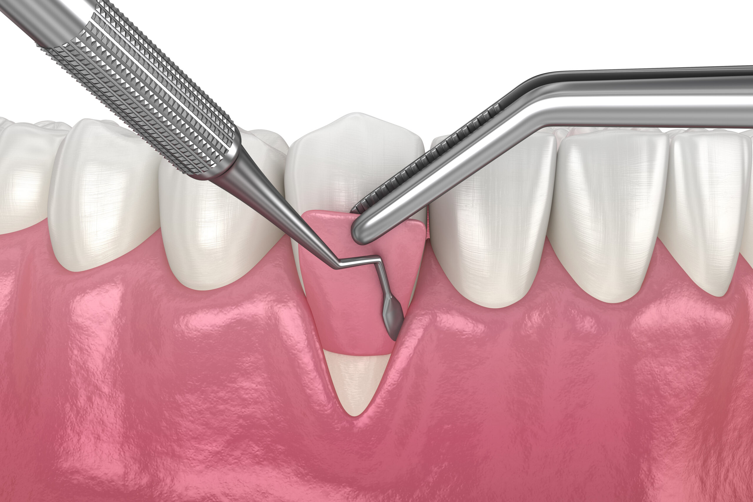 Gum Grafts: Can They Fail?