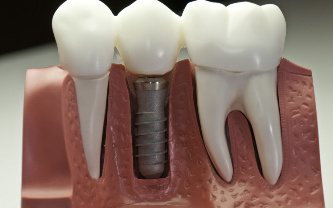Is it Possible to Have Implants With Periodontitis?