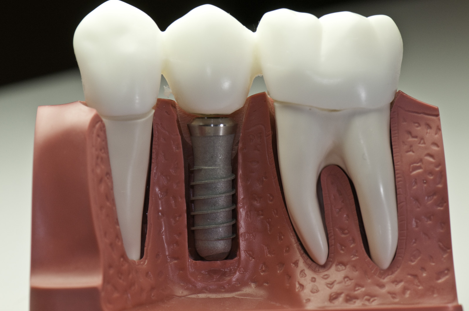 Actual Look of Dental Implants