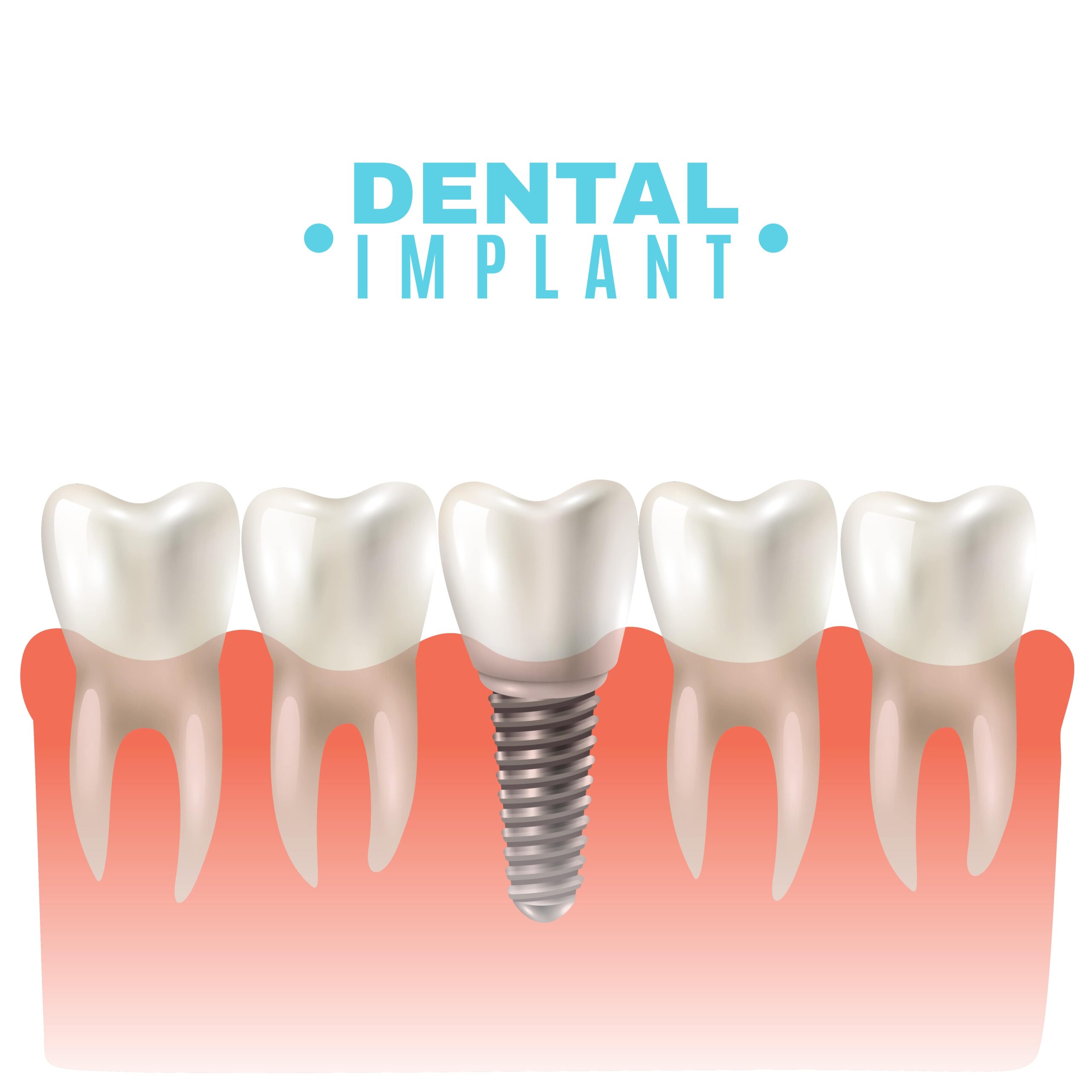 Dental Implant near you in Kelowna