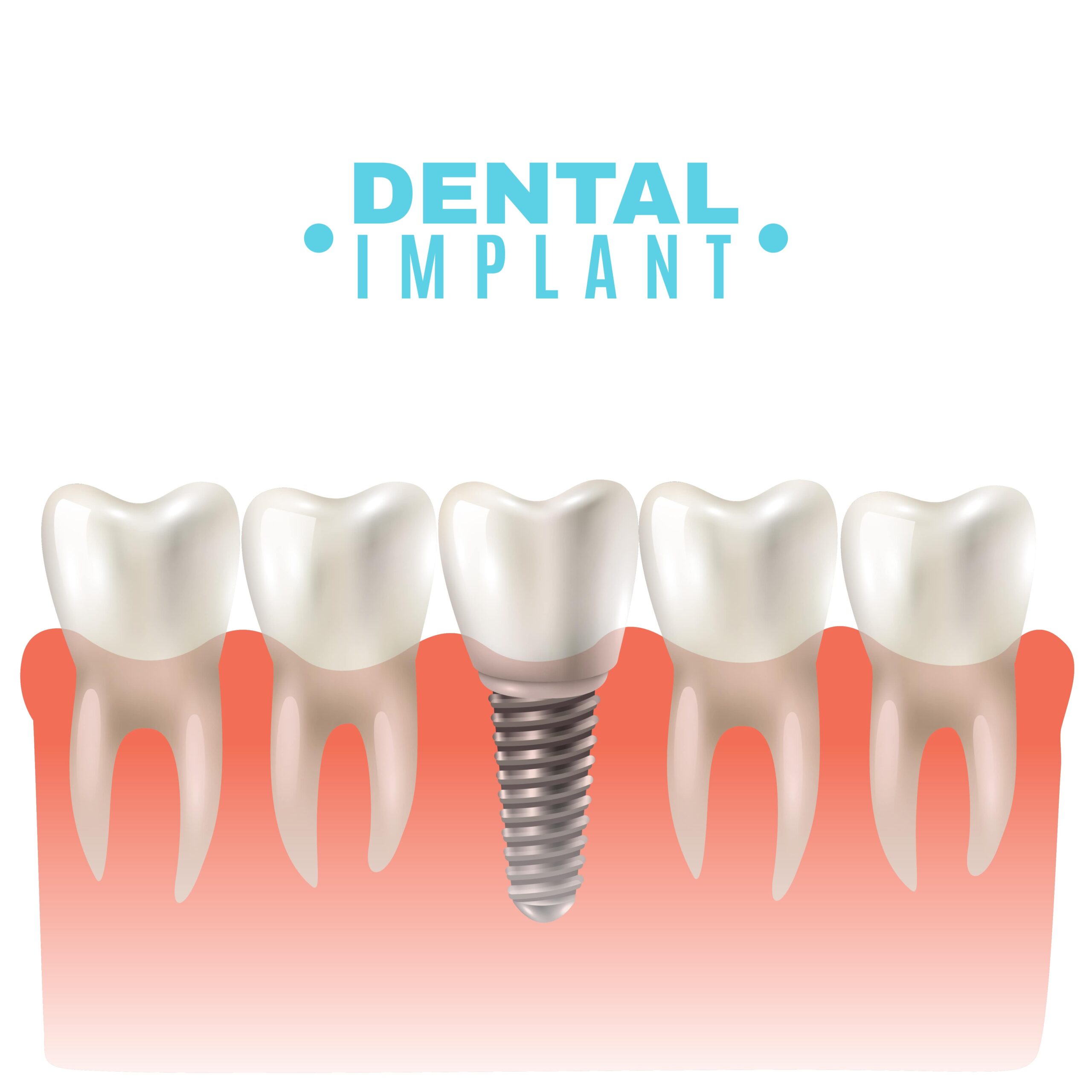 Dental Implant near you in Kelowna Dental Implant near you in Kelowna