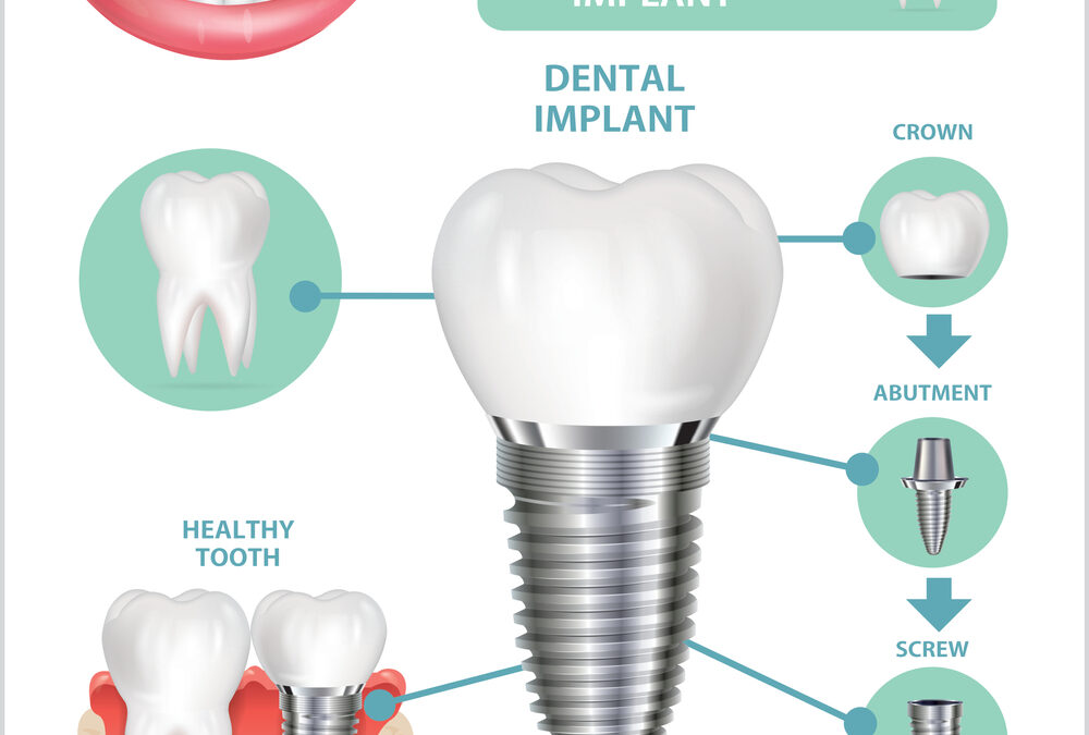 Why You Should Consider Getting a Dental Implant for Tooth Replacement