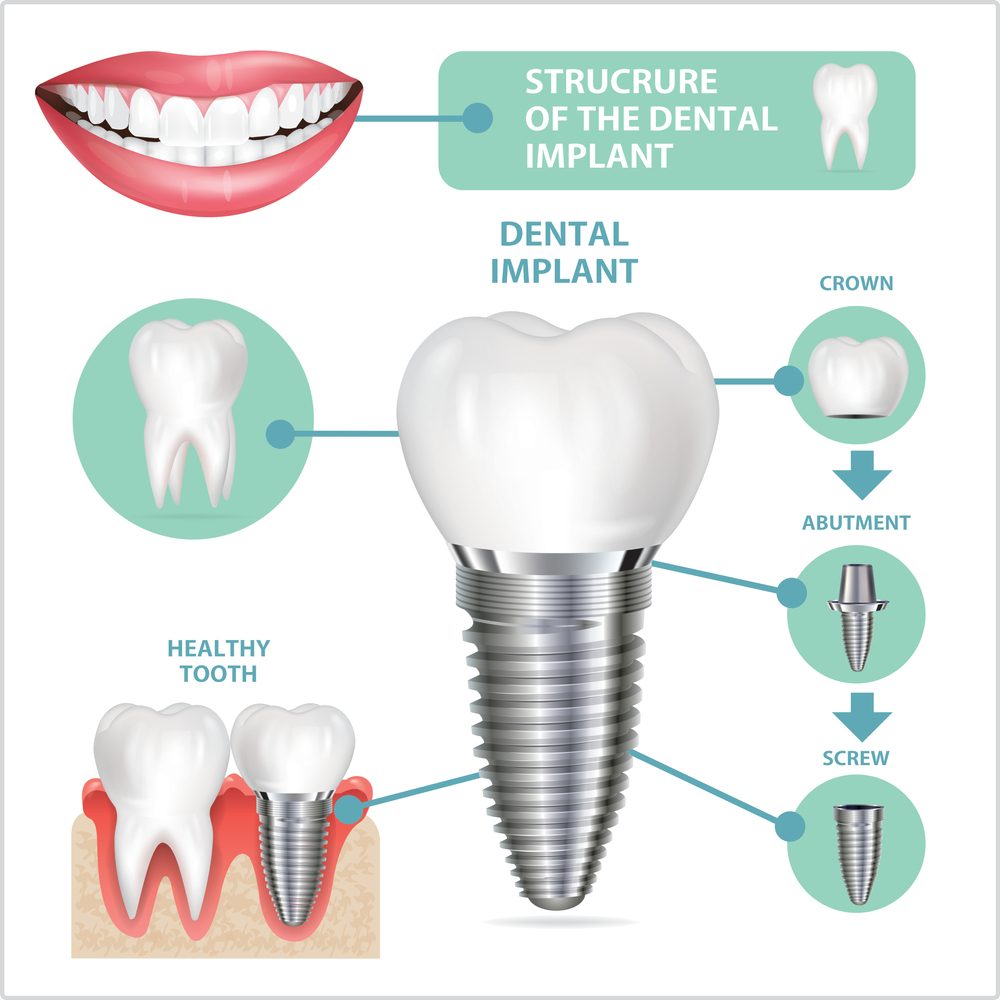 Structure of Dental Implant